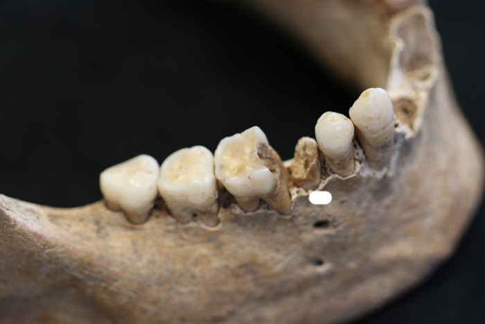 La UAB comprova com els canvis alimentaris han variat els bacteris de la càries