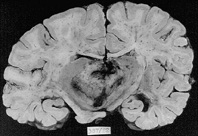 La UAB impulsa un sistema per millorar el diagnòstic de tumor cerebral