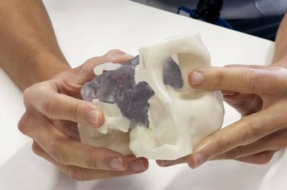 El Parc Taulí inicia amb èxit les cirurgies per extreure tumors de la base del crani a través de l’ull